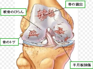 変形性膝関節症と診断された！もしくは膝が長年痛い！